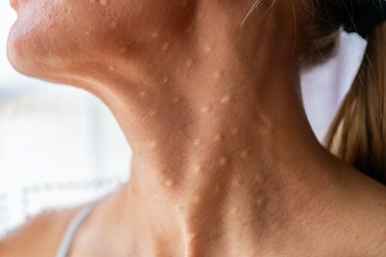 Mesotherapy + CellBooster + NCTF